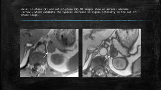 Axial in-phase (a) and out-of-phase (b) MR images show an adrenal adenoma
(arrow), which exhibits the typical decrease in signal intensity on the out-of-
phase image.
 