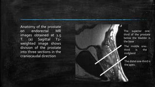 Anatomy of the prostate
on endorectal MR
images obtained at 1.5
T. (a) Sagittal T2-
weighted image shows
division of the prostate
into three sections in the
craniocaudal direction
The superior one-
third of the prostate
below the bladder is
the base
The middle one-
third is the
midgland
The distal one-third is
the apex.
 