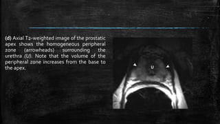 (d) Axial T2-weighted image of the prostatic
apex shows the homogeneous peripheral
zone (arrowheads) surrounding the
urethra (U). Note that the volume of the
peripheral zone increases from the base to
the apex.
 