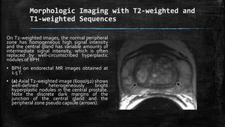 Morphologic Imaging with T2-weighted and
T1-weighted Sequences
On T2-weighted images, the normal peripheral
zone has homogeneous high signal intensity
and the central gland has variable amounts of
intermediate signal intensity, which is often
replaced by well-circumscribed hyperplastic
nodules of BPH
▪ BPH on endorectal MR images obtained at
1.5T.
▪ (a) Axial T2-weighted image (6000/92) shows
well-defined heterogeneously bright
hyperplastic nodules in the central prostate.
Note the discrete dark margins of the
junction of the central gland and the
peripheral zone pseudo capsule (arrows).
 