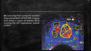 (b) Color map from computer-assisted
diagnosis analysis of DCE MR imaging
data shows a region of interest (ROI)
marking the left hyperplastic nodule
of BPH.
 