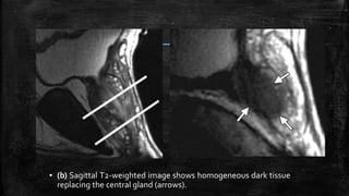 ▪ (b) Sagittal T2-weighted image shows homogeneous dark tissue
replacing the central gland (arrows).
 