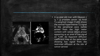 ▪ A 55-year-old man with Gleason 7
(4 + 3) prostate cancer. (a) Axial
T2-weighted image (T2WI) shows
the normal hyperintense T2 signal
in the peripheral zone (white
arrow) from the high water
content with cancer (black arrow)
appearing as an area of low signal
on T2WI. (b) Apparent diffusion
coefficient map at the same level
showing low signal from the
restricted diffusion at the site of
cancer (arrow)
 