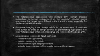▪ The heterogenous appearance with multiple BPH (benign prostate
hyperplasia or benign enlargement of the prostate) nodules makes
assessment for cancer more difficult in the transition zone, especially for
the less-experienced reader.
▪ Functional imaging is not always helpful in the assessment of transition
zone tumor as areas of benign stromal or proliferating hyperplasia may
show heterogenous enhancement on DCE and restricted diffusion on DWI.
▪ Morphological features onT2WI, such as an
– “erased charcoal” appearance ,
– indistinct margins of the nodule,
– extension of low signal into peripheral zone,
– lenticular shape, extension to fibromuscular stroma and local invasion,
 