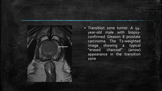 ▪ Transition zone tumor. A 54-
year-old male with biopsy-
confirmed Gleason 8 prostate
carcinoma. The T2-weighted
image showing a typical
“erased charcoal” (arrow)
appearance in the transition
zone
 