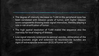 ▪ The degree of intensity decrease on T2WI in the peripheral zone has
been correlated with Gleason grade of tumor, with higher Gleason
score components showing lower signal intensities, thereby playing a
role in risk stratification of tumor.
▪ The high spatial resolution of T2WI makes the sequence also the
mainstay for local staging of disease.
▪ Low signal intensity extension to seminal vesicles, obliteration of the
recto–prostatic angle and extension to neurovascular bundles are
signs of extracapsular extension (ECE) of tumor onT2WI.
 