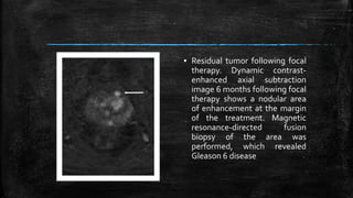 ▪ Residual tumor following focal
therapy. Dynamic contrast-
enhanced axial subtraction
image 6 months following focal
therapy shows a nodular area
of enhancement at the margin
of the treatment. Magnetic
resonance-directed fusion
biopsy of the area was
performed, which revealed
Gleason 6 disease
 