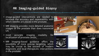 MR Imaging–guided Biopsy
▪ image-guided interventions are needed to
increase the accuracy and repeatability with
which needles are placed in the prostate.
▪ MR imaging provides more detailed anatomic
images of the prostate than does transrectal
US
▪ most accurate imaging modality for
localization of prostate cancer,
▪ MR imaging–based guidance offers the
possibility of more precise targeting, which
may be crucial to the success of modern
diagnostic and local therapeutic interventions
in the prostate.
 