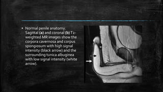 ▪ Normal penile anatomy.
Sagittal (a) and coronal (b)T2-
weighted MR images show the
corpora cavernosa and corpus
spongiosum with high signal
intensity (black arrow) and the
surrounding tunica albuginea
with low signal intensity (white
arrow).
 