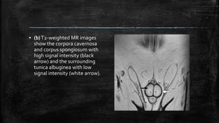 ▪ (b)T2-weighted MR images
show the corpora cavernosa
and corpus spongiosum with
high signal intensity (black
arrow) and the surrounding
tunica albuginea with low
signal intensity (white arrow).
 