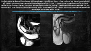 Penile trauma. (a) SagittalT2-weighted MR image in a 43-year-old man shows a focal region of low signal intensity in the
left corpus cavernosum (black arrow) without disruption of theT1- andT2-hypointense tunica albuginea fibrous band
(white arrow), findings that are consistent with penile contusion. (b) SagittalT2-weighted MR image in a 17-year-old boy
demonstrates focal disruption of the hypointense tunica albuginea of the left corpus cavernosum (black arrow) associated
with a large hematocele (white arrow)
 