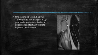 ▪ Undescended testis. Sagittal
T2-weighted MR image in a 44-
year-old man demonstrates an
undescended testis in the left
inguinal canal (arrow
 