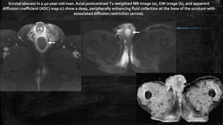 Scrotal abscess in a 40-year-old man. Axial postcontrastT1-weighted MR image (a), DW image (b), and apparent
diffusion coefficient (ADC) map (c) show a deep, peripherally enhancing fluid collection at the base of the scrotum with
associated diffusion restriction (arrow).
 