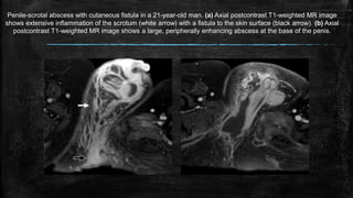 Penile-scrotal abscess with cutaneous fistula in a 21-year-old man. (a) Axial postcontrast T1-weighted MR image
shows extensive inflammation of the scrotum (white arrow) with a fistula to the skin surface (black arrow). (b) Axial
postcontrast T1-weighted MR image shows a large, peripherally enhancing abscess at the base of the penis.
 