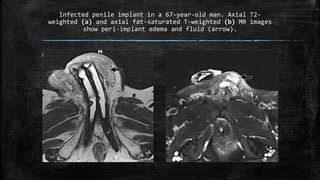 Infected penile implant in a 67-year-old man. Axial T2-
weighted (a) and axial fat-saturated T-weighted (b) MR images
show peri-implant edema and fluid (arrow).
 