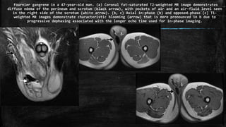 Fournier gangrene in a 47-year-old man. (a) Coronal fat-saturated T2-weighted MR image demonstrates
diffuse edema of the perineum and scrotum (black arrow), with pockets of air and an air-fluid level seen
in the right side of the scrotum (white arrow). (b, c) Axial in-phase (b) and opposed-phase (c) T1-
weighted MR images demonstrate characteristic blooming (arrow) that is more pronounced in b due to
progressive dephasing associated with the longer echo time used for in-phase imaging.
 