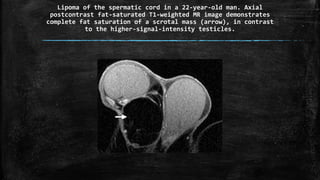 Lipoma of the spermatic cord in a 22-year-old man. Axial
postcontrast fat-saturated T1-weighted MR image demonstrates
complete fat saturation of a scrotal mass (arrow), in contrast
to the higher-signal-intensity testicles.
 