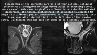Liposarcoma of the spermatic cord in a 63-year-old man. (a) Axial
postcontrast T1-weighted MR image demonstrates an enhancing scrotal
mass (arrow), which was surgically confirmed to be a dedifferentiated
liposarcoma. (b) Coronal postcontrast fat-saturated T1-weighted MR
image in a different patient demonstrates an irregular, enhancing soft-
tissue mass with internal lipid in the left side of the scrotum
(arrow), a finding that was also confirmed to be a scrotal liposarcoma.
 