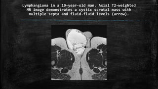 Lymphangioma in a 19-year-old man. Axial T2-weighted
MR image demonstrates a cystic scrotal mass with
multiple septa and fluid-fluid levels (arrow).
 