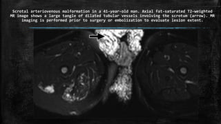 Scrotal arteriovenous malformation in a 41-year-old man. Axial fat-saturated T2-weighted
MR image shows a large tangle of dilated tubular vessels involving the scrotum (arrow). MR
imaging is performed prior to surgery or embolization to evaluate lesion extent.
 