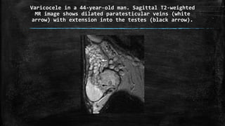 Varicocele in a 44-year-old man. Sagittal T2-weighted
MR image shows dilated paratesticular veins (white
arrow) with extension into the testes (black arrow).
 