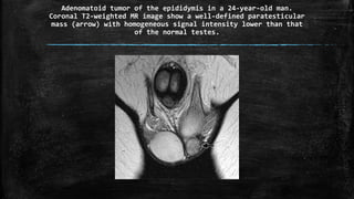 Adenomatoid tumor of the epididymis in a 24-year-old man.
Coronal T2-weighted MR image show a well-defined paratesticular
mass (arrow) with homogeneous signal intensity lower than that
of the normal testes.
 