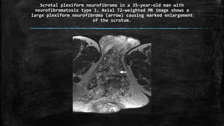 Scrotal plexiform neurofibroma in a 35-year-old man with
neurofibromatosis type 1. Axial T2-weighted MR image shows a
large plexiform neurofibroma (arrow) causing marked enlargement
of the scrotum.
 