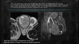 Testicular germ cell tumor in a 23-year-old man. Axial T2-weighted (a) and coronal
postcontrast T1-weighted (b) MR images demonstrate a large enhancing mass infiltrating the
right testis (black arrow) and a necrotic tumor in the left testis (white arrow). Results
of bilateral orchiectomy confirmed seminoma of both testes
Note the asymmetric enlargement of the right
thigh (a) related to Klippel-Trénaunay-Weber syndrome.
 
