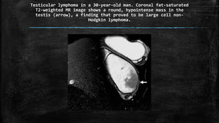 Testicular lymphoma in a 30-year-old man. Coronal fat-saturated
T2-weighted MR image shows a round, hypointense mass in the
testis (arrow), a finding that proved to be large cell non-
Hodgkin lymphoma.
 