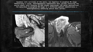 Squamous cell carcinoma of the penis. (a) Sagittal T2-weighted MR image
demonstrates a large, heterogeneously hypointense mass (arrow) involving the
penile shaft, with invasion of the corpus cavernosum. (b) Axial postcontrast
fat-saturated T1-weighted MR image in a different patient demonstrates a
heterogeneously enhancing penile mass (arrow).
 