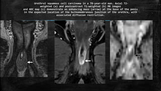 Urethral squamous cell carcinoma in a 78-year-old man. Axial T2-
weighted (a) and postcontrast T1-weighted (b) MR images
and ADC map (c) demonstrate an enhancing mass (arrow) at the base of the penis
in the expected location of the bulbomembranous junction of the urethra, with
associated diffusion restriction.
 