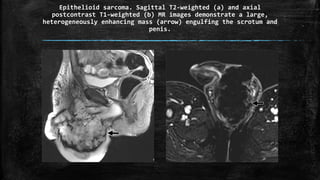 Epithelioid sarcoma. Sagittal T2-weighted (a) and axial
postcontrast T1-weighted (b) MR images demonstrate a large,
heterogeneously enhancing mass (arrow) engulfing the scrotum and
penis.
 