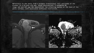 Metastasis to the penis from a primary transitional cell carcinoma of the
bladder in a 65-year-old man. Axial postcontrast T1-weighted MR
image (a) and ADC map (b) demonstrate two enhancing masses at the base of the
penis (arrow), with associated diffusion restriction.
 
