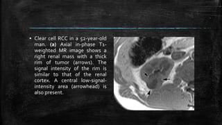 ▪ Clear cell RCC in a 52-year-old
man. (a) Axial in-phase T1-
weighted MR image shows a
right renal mass with a thick
rim of tumor (arrows). The
signal intensity of the rim is
similar to that of the renal
cortex. A central low-signal-
intensity area (arrowhead) is
also present.
 