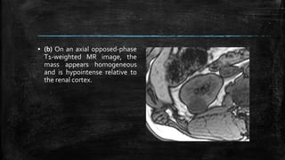 ▪ (b) On an axial opposed-phase
T1-weighted MR image, the
mass appears homogeneous
and is hypointense relative to
the renal cortex.
 