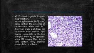 ▪ (c) Photomicrograph (original
magnification, ×10;
hematoxylin-eosin [H-E] stain)
helps confirm the presence of
conventional (clear cell) RCC
(Fuhrman grade 1–2). Clear cell
cytoplasm may contain lipid
that is responsible for the loss
of signal intensity on opposed-
phase MR images. Many tumor
cells contain finely granular
eosinophilic cytoplasm.
 