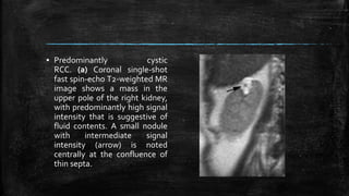 ▪ Predominantly cystic
RCC. (a) Coronal single-shot
fast spin-echo T2-weighted MR
image shows a mass in the
upper pole of the right kidney,
with predominantly high signal
intensity that is suggestive of
fluid contents. A small nodule
with intermediate signal
intensity (arrow) is noted
centrally at the confluence of
thin septa.
 