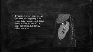 ▪ (b) Coronal subtraction image
(postcontrast nephrographic
phase data – precontrast data)
shows enhancement of the
small central nodule (arrow)
within the mass.
 