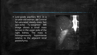 ▪ Low-grade papillary RCC in a
70-year-old woman. (a) Coronal
fat-saturated steady-state fast
spin-echo T2-weighted MR
image shows a small mass
(arrow) in the upper pole of the
right kidney. The mass is
homogeneously hypointense
relative to the adjacent renal
parenchyma.
 
