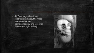 ▪ (b) On a sagittal oblique
subtraction image, the mass
(arrow) enhances
homogeneously and less than
the normal right kidney.
 