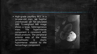▪ High-grade papillary RCC in a
70-year-old man. (a) Sagittal
unenhanced 3D fat-saturated
GRE T1-weighted MR image
shows a large, heterogeneous
mass. The hyperintense
component is consistent with
blood products. The peripheral
anterior area of the mass
(arrowheads) is clearly
hypointense relative to the
hemorrhagic component.
 