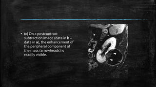 ▪ (c) On a postcontrast
subtraction image (data in b –
data in a), the enhancement of
the peripheral component of
the mass (arrowheads) is
readily visible.
 