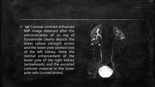 ▪ (a) Coronal contrast-enhanced
MIP image obtained after the
administration of 10 mg of
furosemide clearly depicts the
lower calices (straight arrow)
and the lower pole (dotted line)
of the left kidney. Note the
normal enhancement of the
lower pole of the right kidney
(arrowheads) and the excreted
contrast material in the lower
pole calix (curved arrow).
 