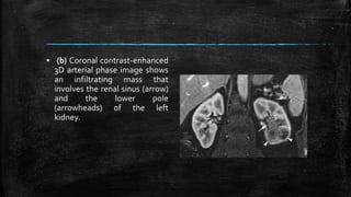 ▪ (b) Coronal contrast-enhanced
3D arterial phase image shows
an infiltrating mass that
involves the renal sinus (arrow)
and the lower pole
(arrowheads) of the left
kidney.
 
