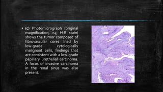 ▪ (c) Photomicrograph (original
magnification, ×4; H-E stain)
shows the tumor composed of
fibrovascular cores lined by
low-grade cytologically
malignant cells, findings that
are consistent with a low-grade
papillary urothelial carcinoma.
A focus of invasive carcinoma
in the renal sinus was also
present.
 