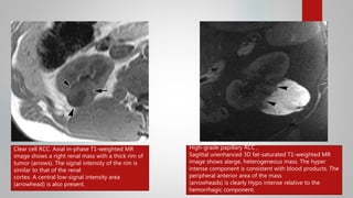 Small Rcc Mri Mri in urology | PPTX