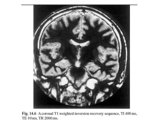 Mri inversion | PPTX