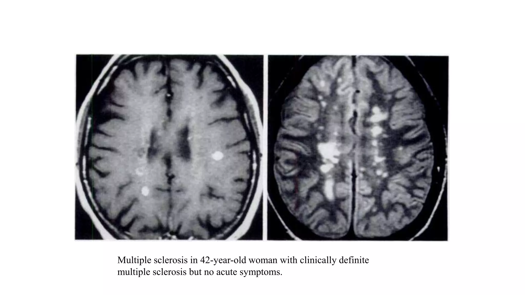 Mri in white matter diseases | PPTX
