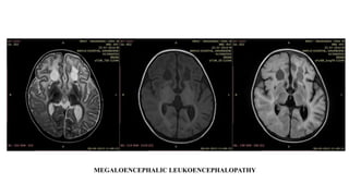 MEGALOENCEPHALIC LEUKOENCEPHALOPATHY
 