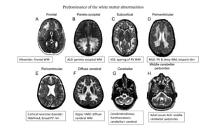 Predominance of the white matter abnormalities
Alexander: frontal WM ALD: parieto occipital WM KSS: sparing of PV WM MLD: PV & deep WM, leopard skin
Cortical neuronal disorder:
illdefined, broad PV rim
Hypo/ VMD: diffuse
cerebral WM
Cerebrotendinous
Xanthomatosis:
cerebellar> cerebral
Adult onset ALD: middle
cerebellar peduncles
 